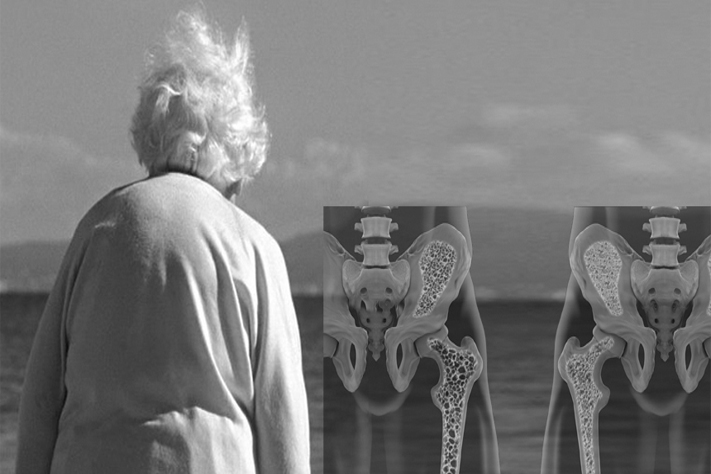 Path to recovery from Osteoporosis 