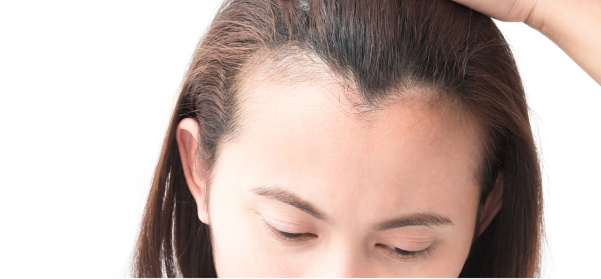 THE CAUSES OF FEMALE PATTERN BALDNESS