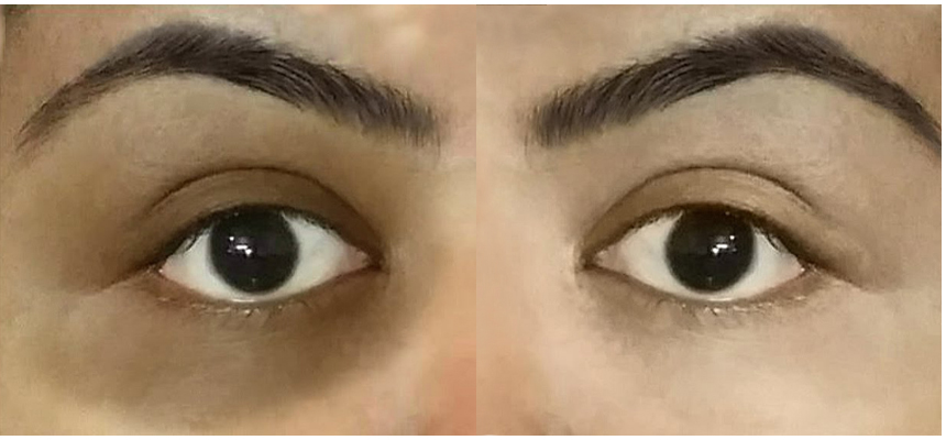 Easy Remedies to Erase Dark Circles