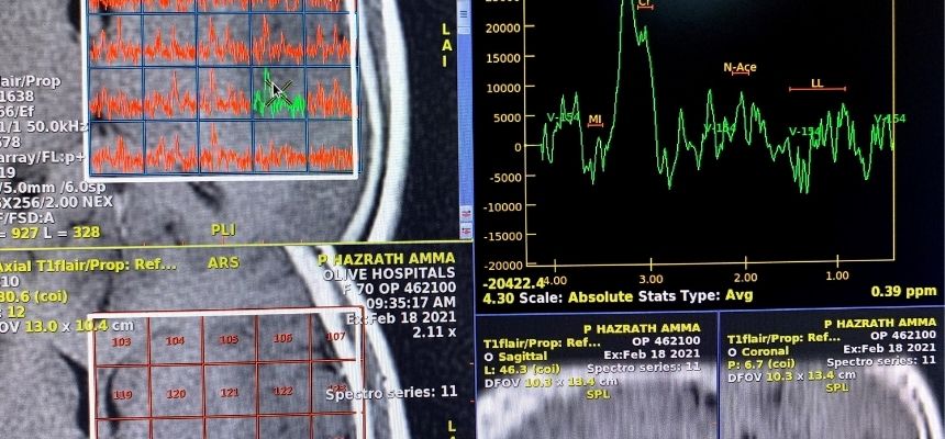 PROFICIENT RADIOLOGIST AT OLIVE HOSPITALS DECODES A MISDIAGNOSED CASE Identified and Detected a Rare Brain Tumor