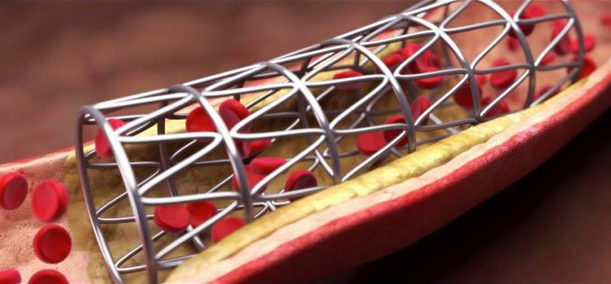 Stents: A challenge for â€˜Make in Indiaâ€™