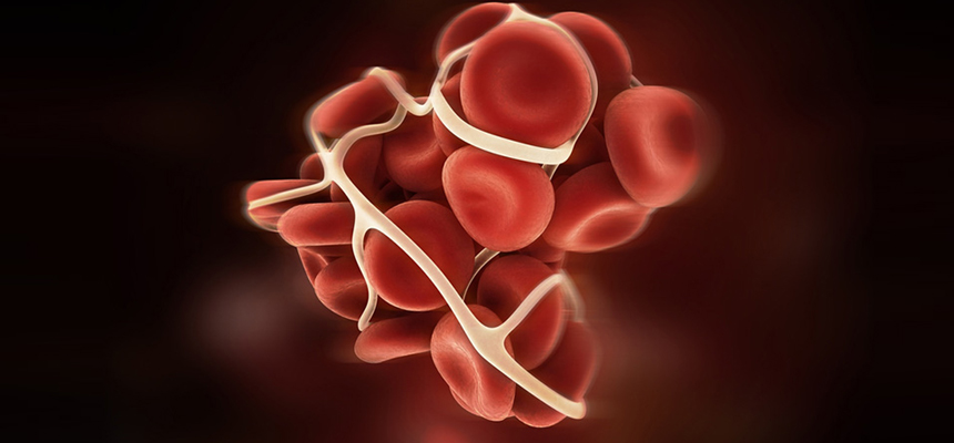 Deep Vein Thrombosis in six times more in pregnant women 