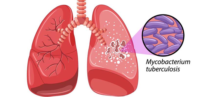 Misdiagnosis of lung mass is taken as TB 