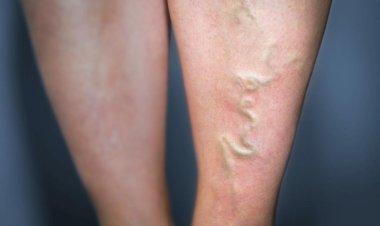VARICOSE VEINS - A GUIDE TO UNDERSTANDING AND PREVENTING THEM