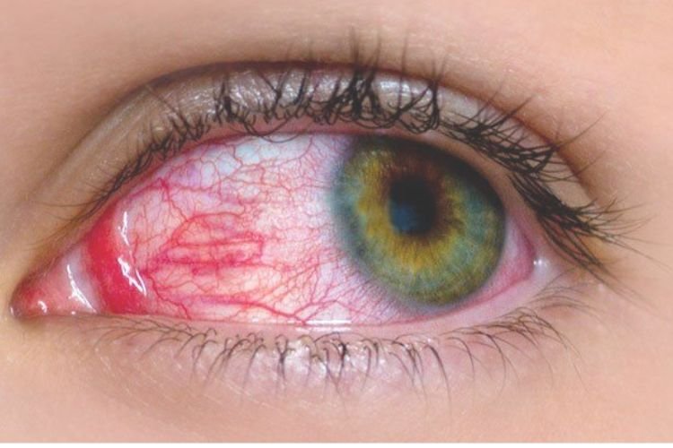 Pink eye (Conjunctivitis)