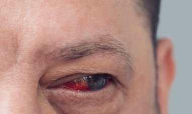 SJOGREN’S – DIAGNOSIS AND TREATMENT