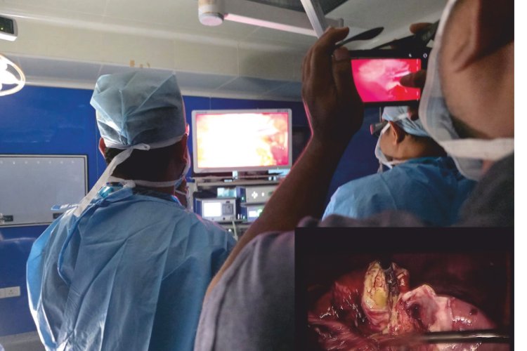 Surgeons at CARE Hospitals, Malakpet Save 72-Year-Old Woman Through High-Risk Laparoscopic Gallbladder Surgery