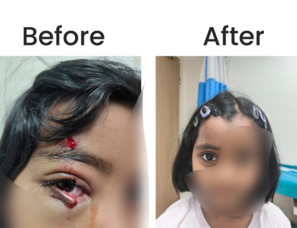 KIMS Hospitals Restores Vision Function in Six-Year-Old with Complex Eyelid Reconstruction