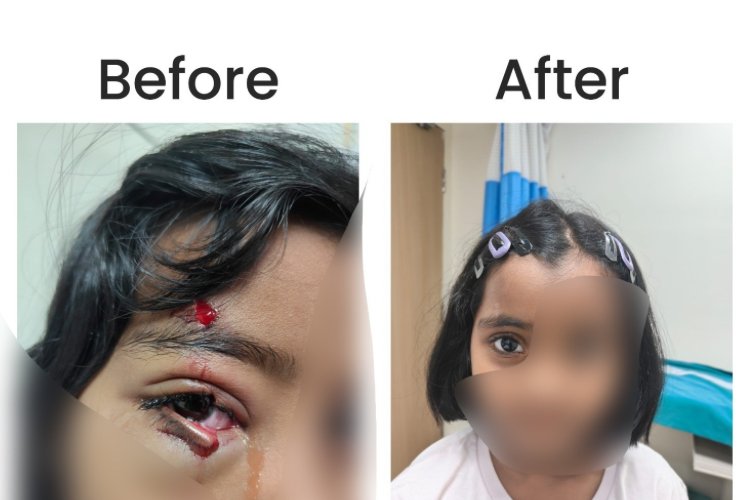 KIMS Hospitals Restores Vision Function in Six-Year-Old with Complex Eyelid Reconstruction
